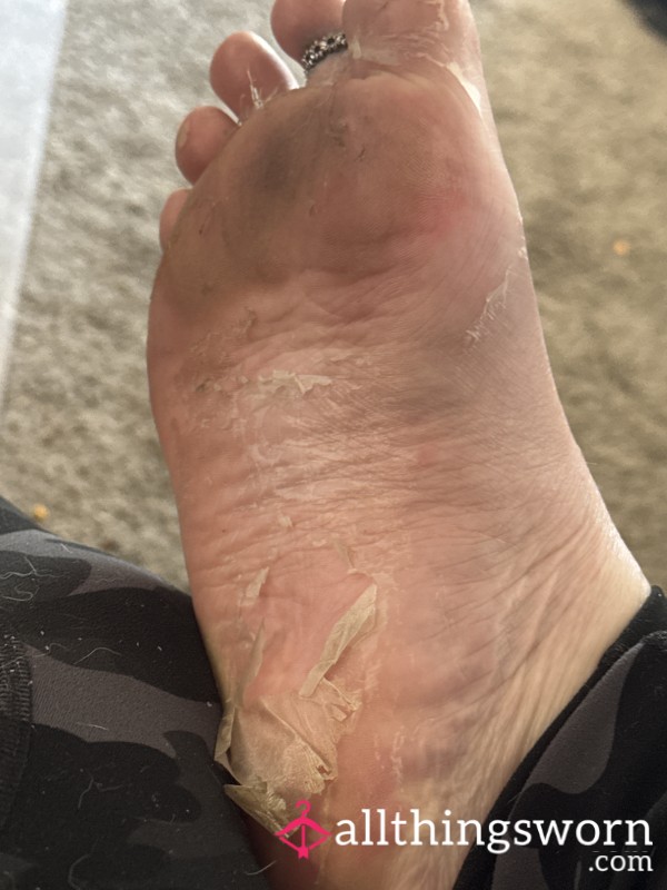 Foot Crust/dust