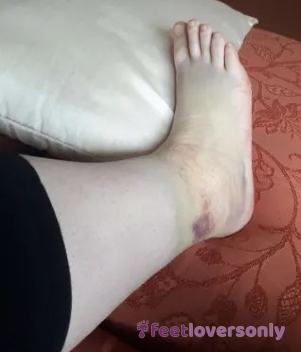 Sprained Ankle